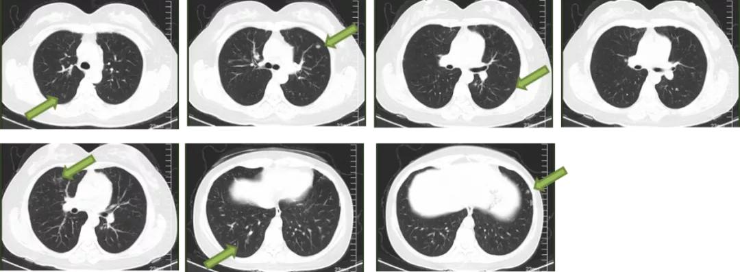 双肺多发结节，反复检查为何诊断重点成「盲区」？