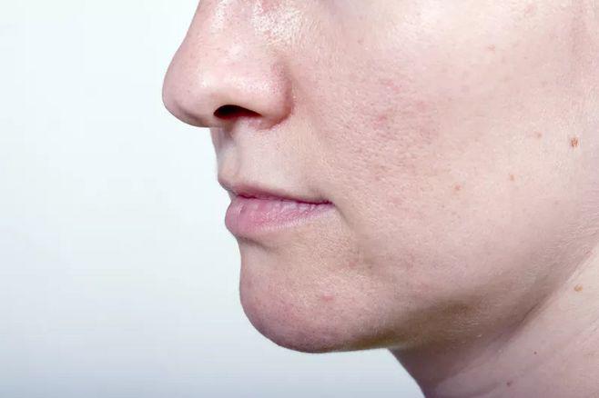 混合性肌肤毛孔粗大如何改善,改善毛孔粗大出油的方法