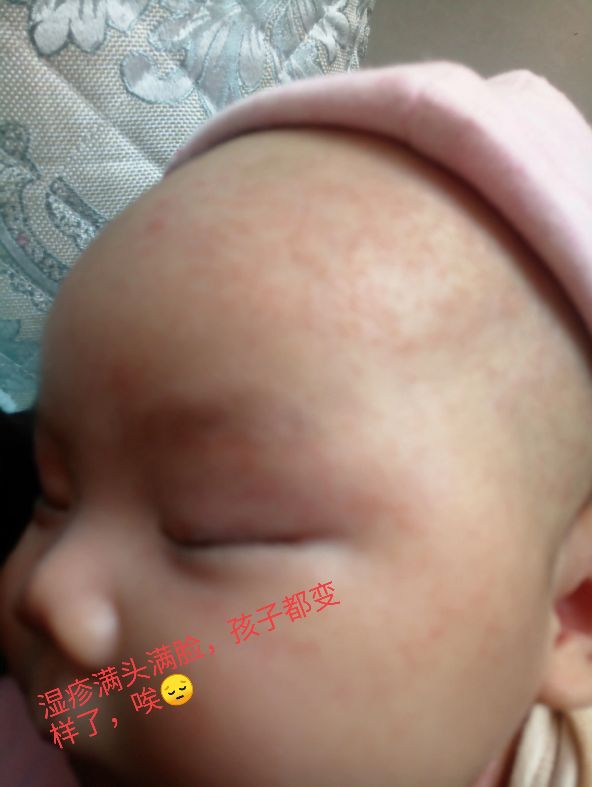 家有湿疹娃是什么体验,家有宝宝必会急救知识