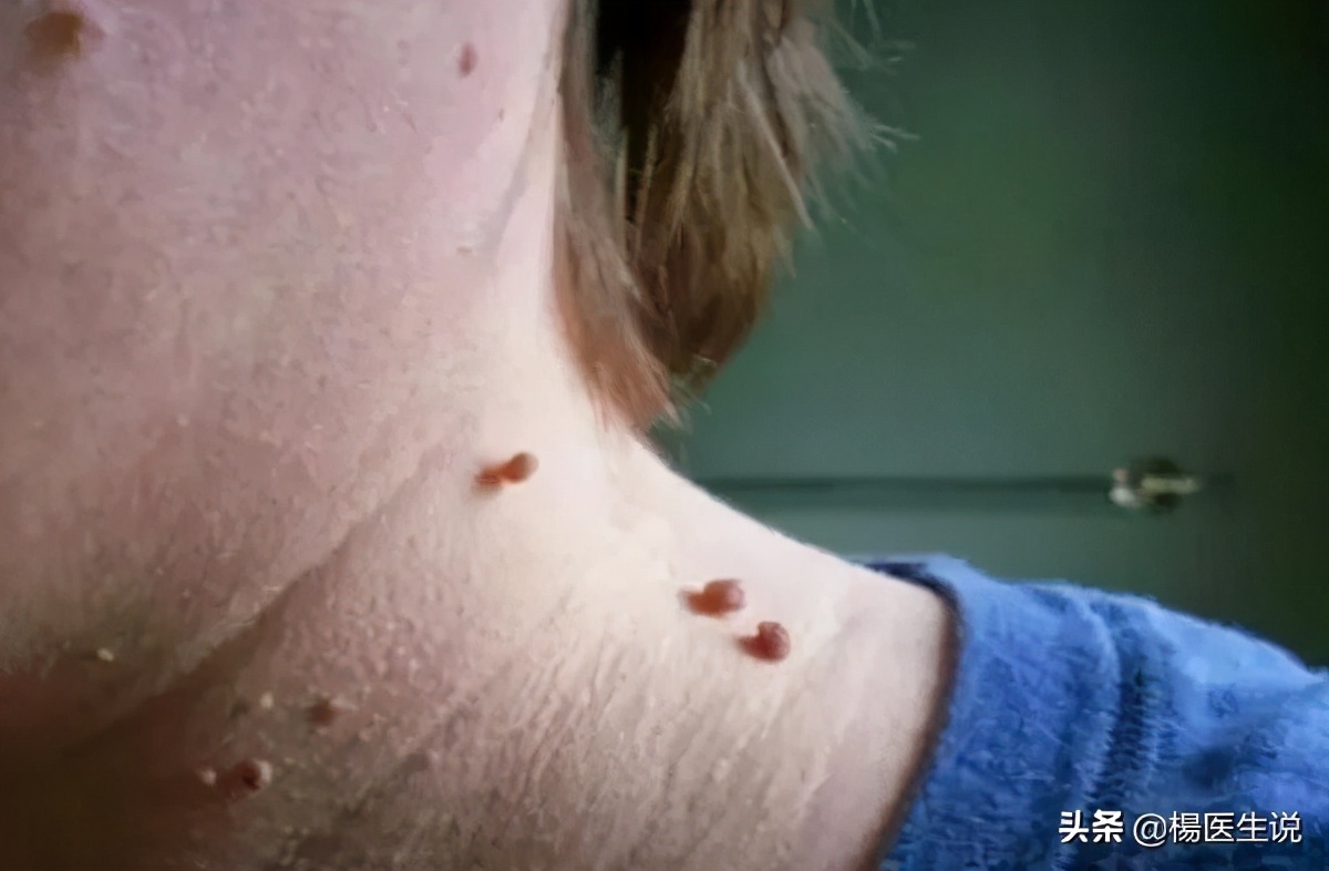 耳朵脖子后面长了个肉瘤叫什么病,脖子上小肉瘤用什么药去除