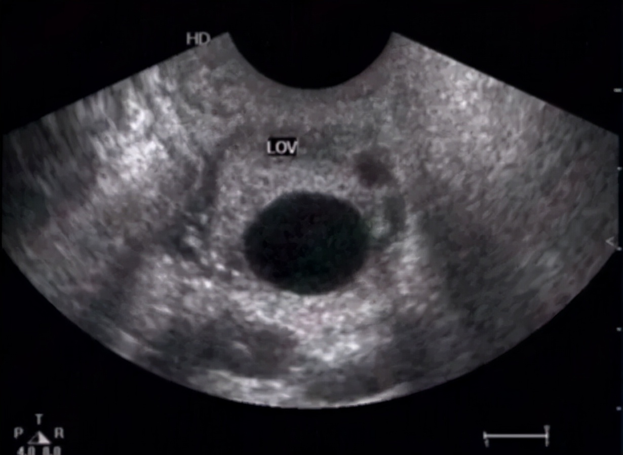 体检发现卵巢囊肿后面复查没有了,月经前体检卵巢囊肿