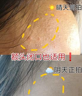 这6种办法能助你快速去闭口,去闭口最简单的消除方法