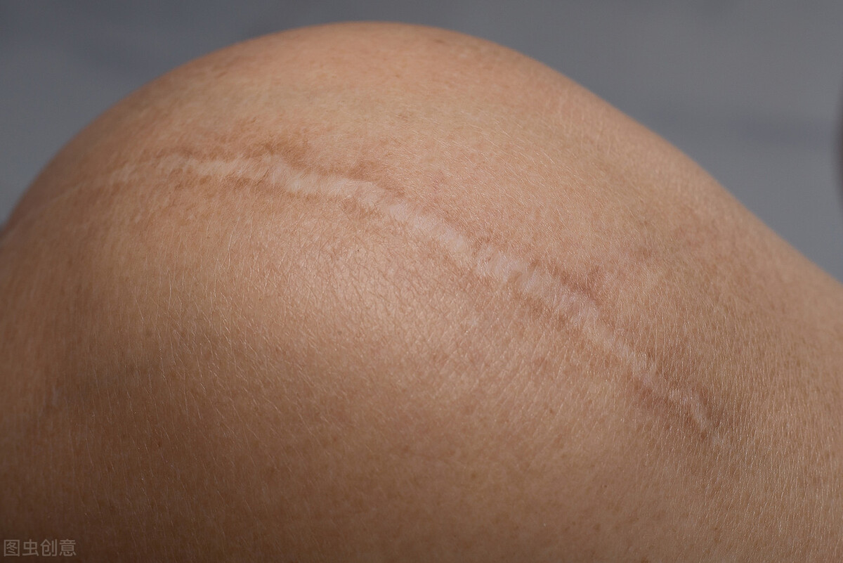 红色疤痕可以恢复到正常肤色吗,褐色的疤痕