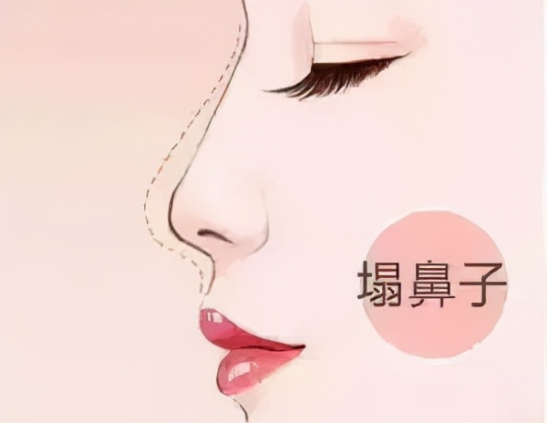 怎么日常改变鼻型,鼻型不好看怎么调整