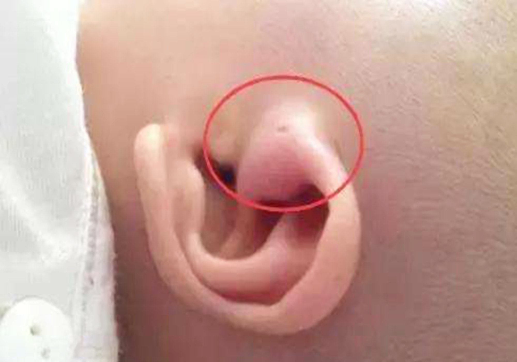 小孩一出生就有耳孔,宝宝有耳孔必须手术吗