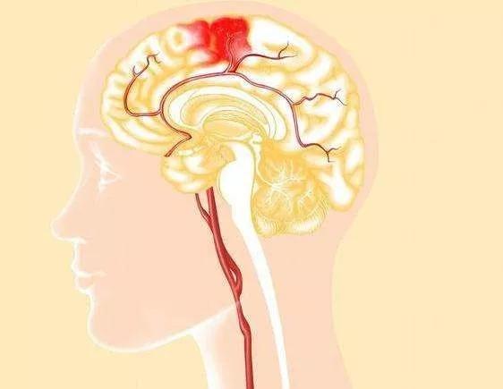 《中国脑出血诊断治疗规范指南》解读