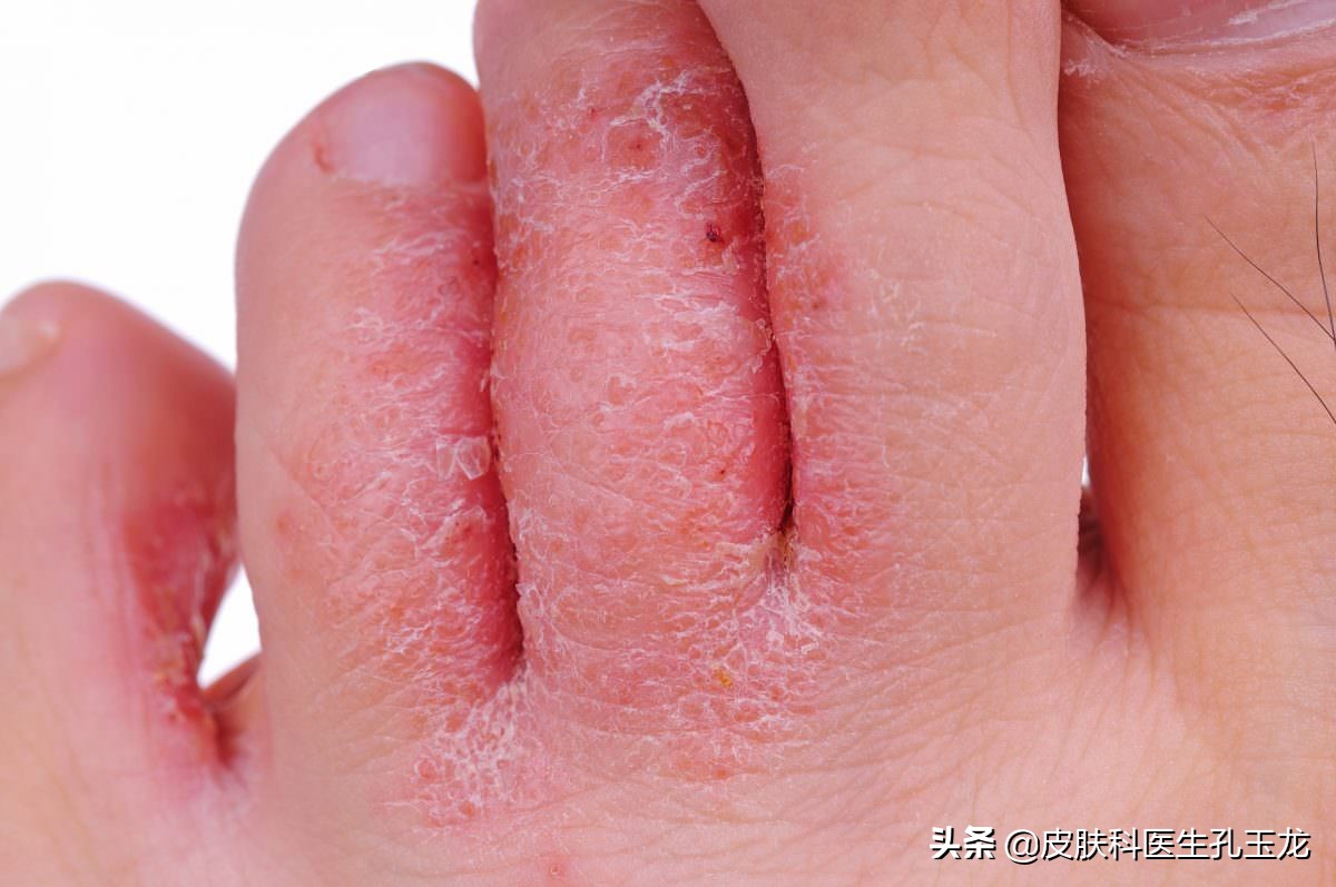 医院皮肤科医生治脚气用什么药,皮肤科医生脚气脚臭怎么办