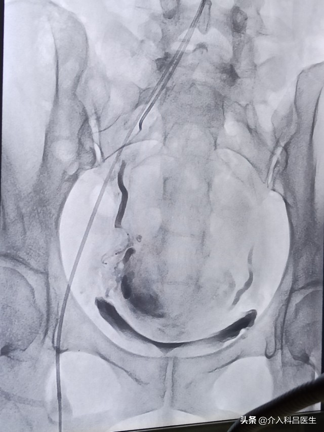 不死的癌症肠易激综合征,不死的癌症中医治疗