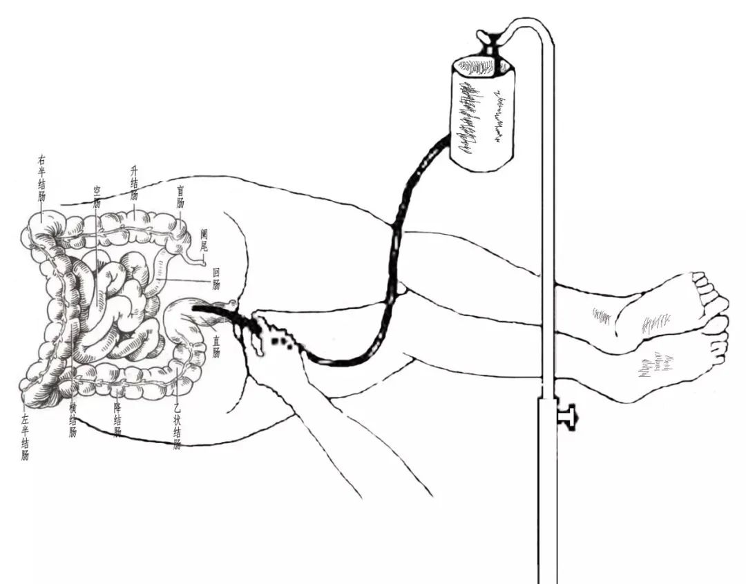 灌肠是什么感受,灌肠是什么样的感觉