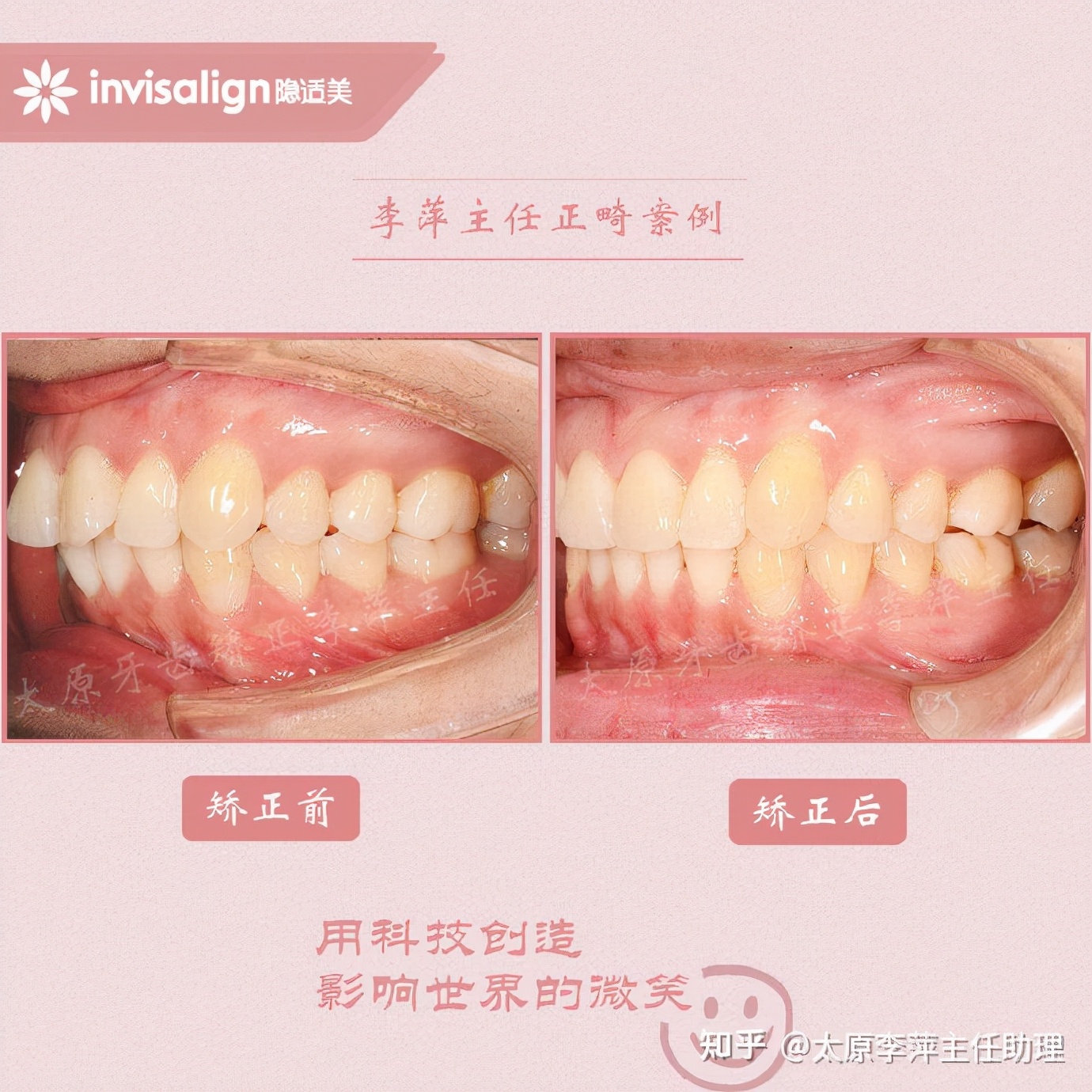 重度拥挤矫正牙齿适合隐形牙套吗,广州成人牙齿矫正推荐隐形牙套