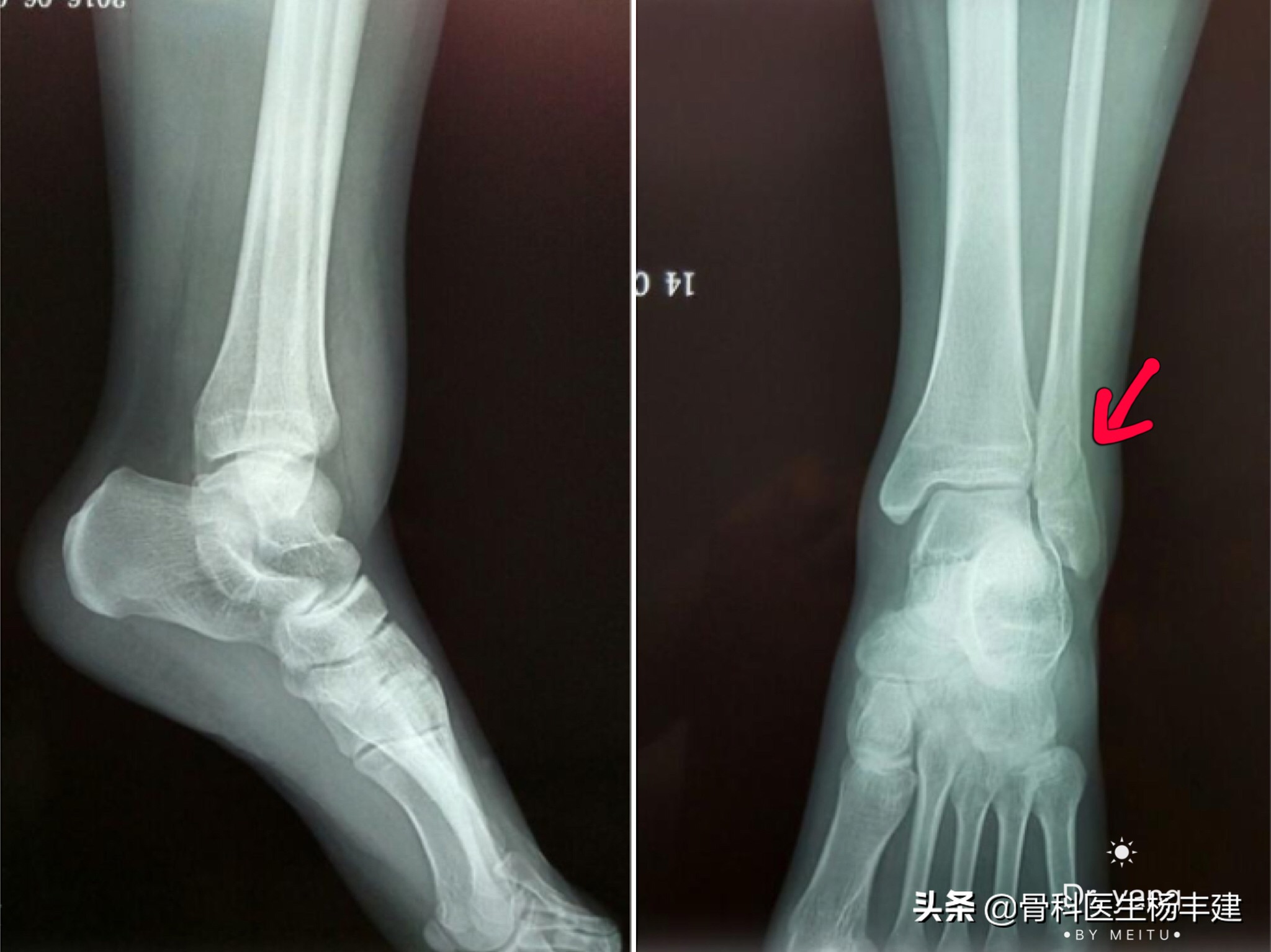 脚踝骨折做手术大概多少钱,右脚踝骨折做手术要多少小时