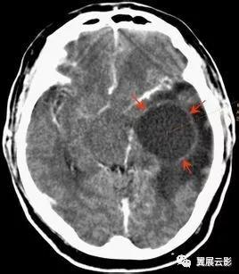 脑部脓肿怎么治疗,多发性脑脓肿能自愈吗