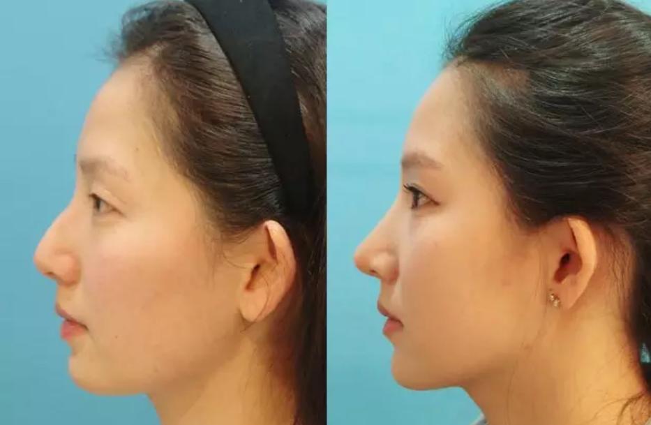 侧面好看和正面好看哪个好,女生侧面怎么才好看