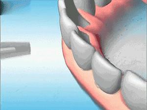 牙齿上火牙龈痛怎么止痛,牙龈肿是牙齿坏了还是上火引起的