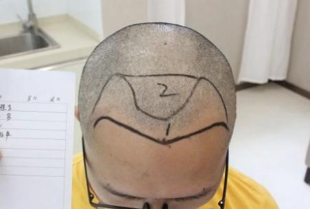 男性m型脱发是脂溢性脱发吗,m型脱发还在继续脱发怎么办