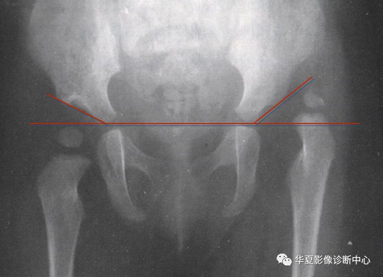 先天性髋关节脱位截骨术全过程,先天性髋关节脱位可以考驾驶证吗