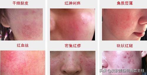 皮肤屏障受损可以吃什么药来修复,脸上皮肤屏障受损用什么护肤品好