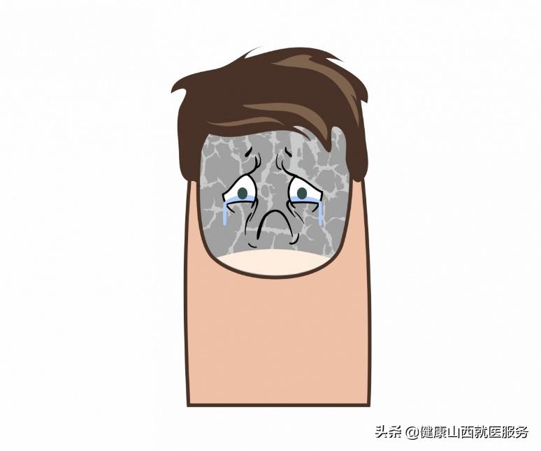 得了灰指甲怎么办能治好吗,得了灰指甲怎么办才能治好