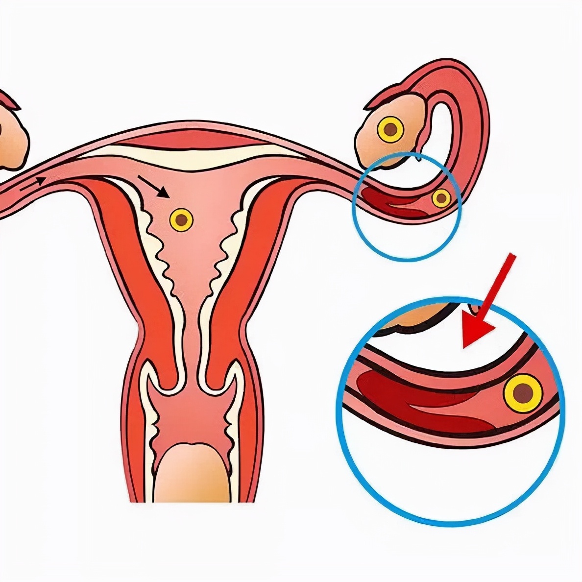 中医喊你来治疗慢性盆腔炎，多的是你不知道的优势
