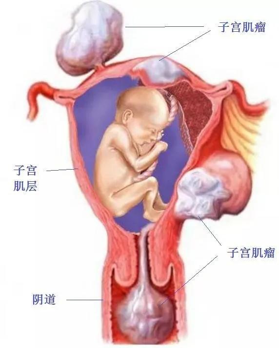 当孕妈妈遇上了子宫肌瘤,子宫肌瘤孕妈妈
