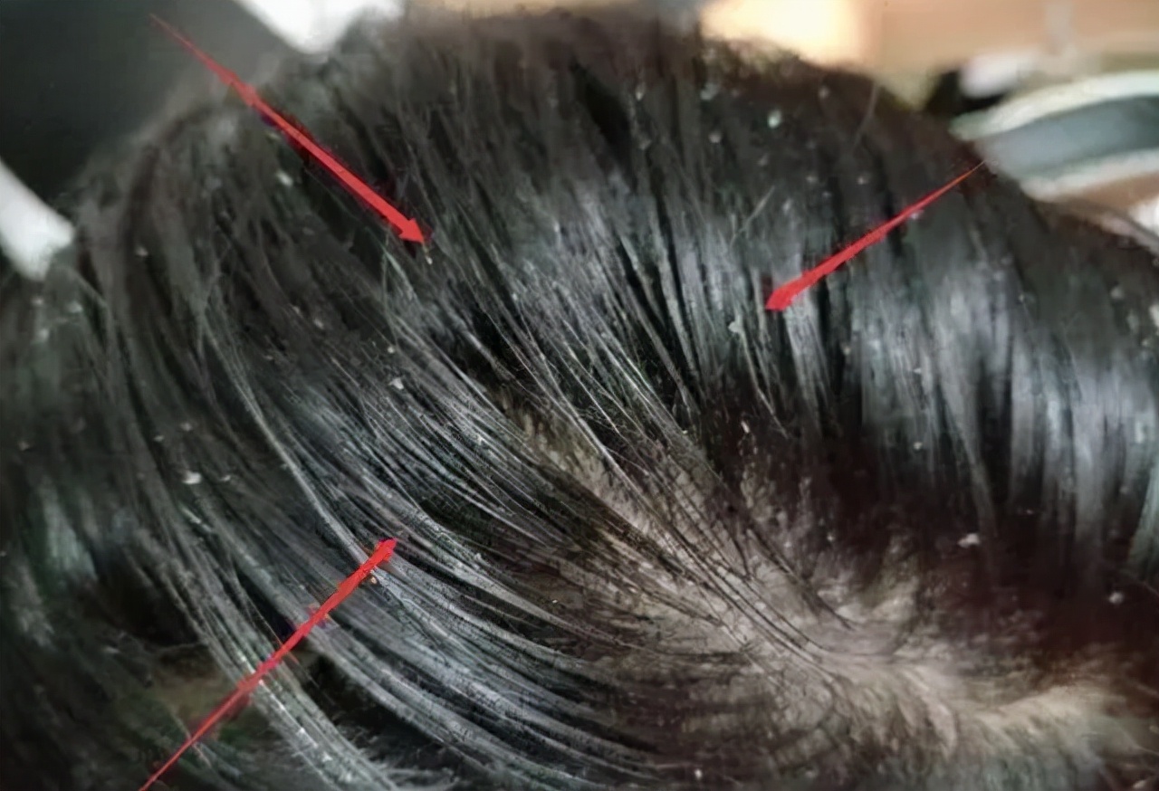 头皮上总出油长有疙瘩或脓包,头皮老是长疙瘩是咋回事