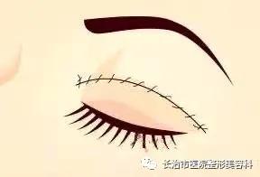 揭秘整形双眼皮内幕,割双眼皮术的价格