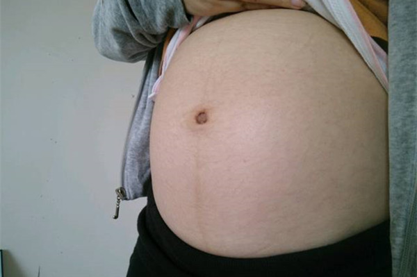 孕妈妈妊娠纹怎么缓解,孕妈妈长纹了怎么办