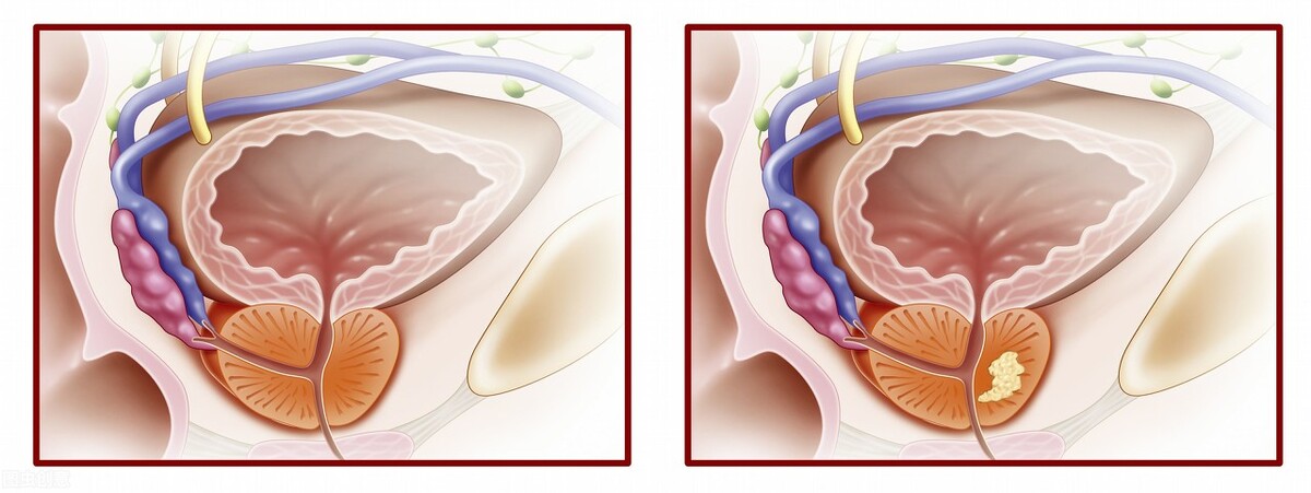 得了前列腺能喝茶吗,得了前列腺能不能喝枸杞