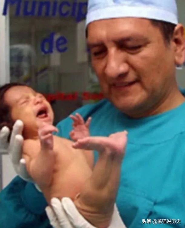 美人鱼真实存在的5件事,美人鱼婴儿畸形手术