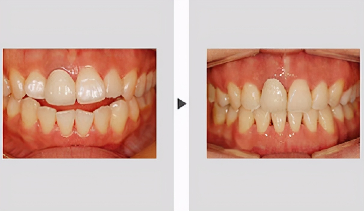 牙齿矫正黑幕素材,牙齿正畸内幕