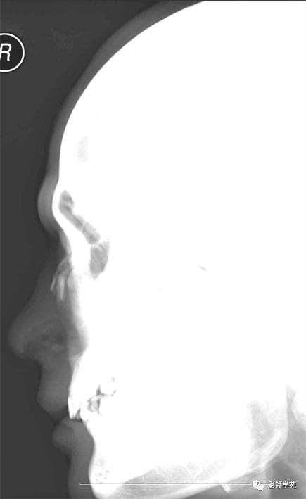 鼻骨骨折的检查方法,鼻骨骨折影像学表现