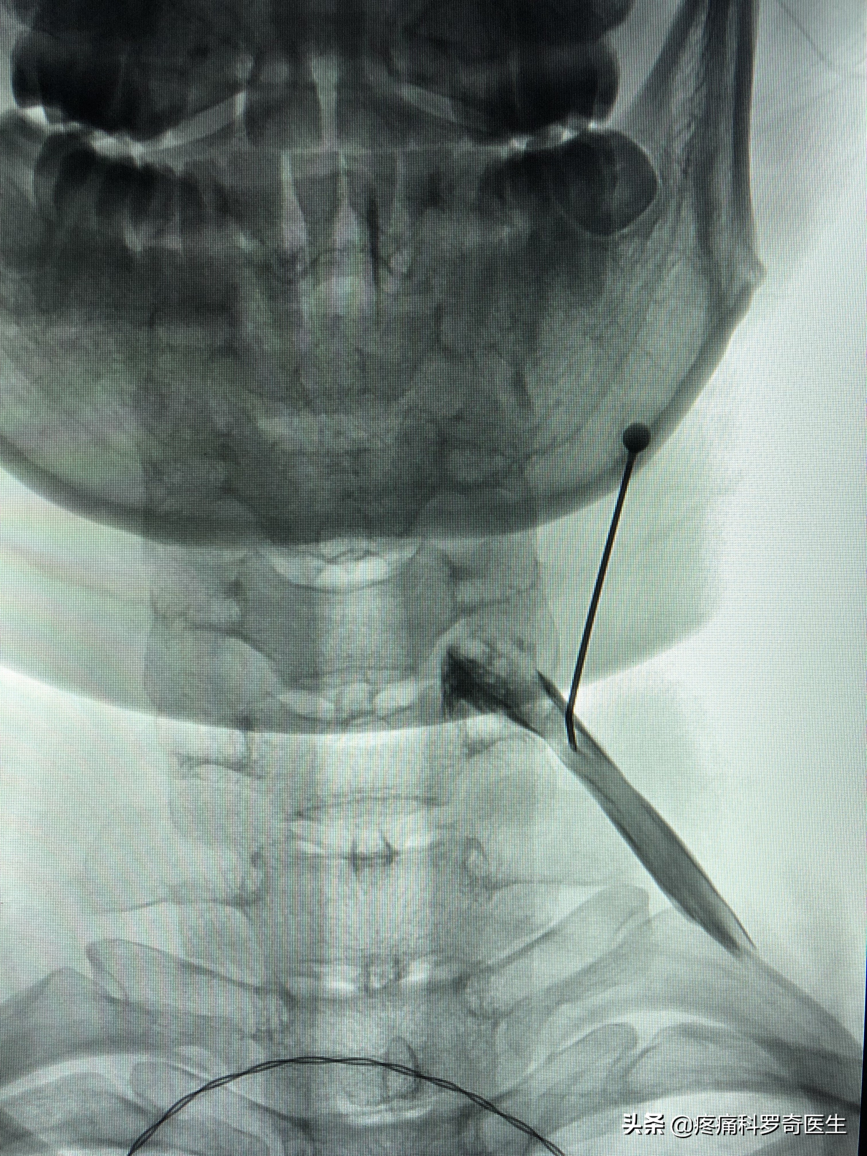 颈椎病除了手术还能治好吗,颈椎病除了针灸还有其他方法吗