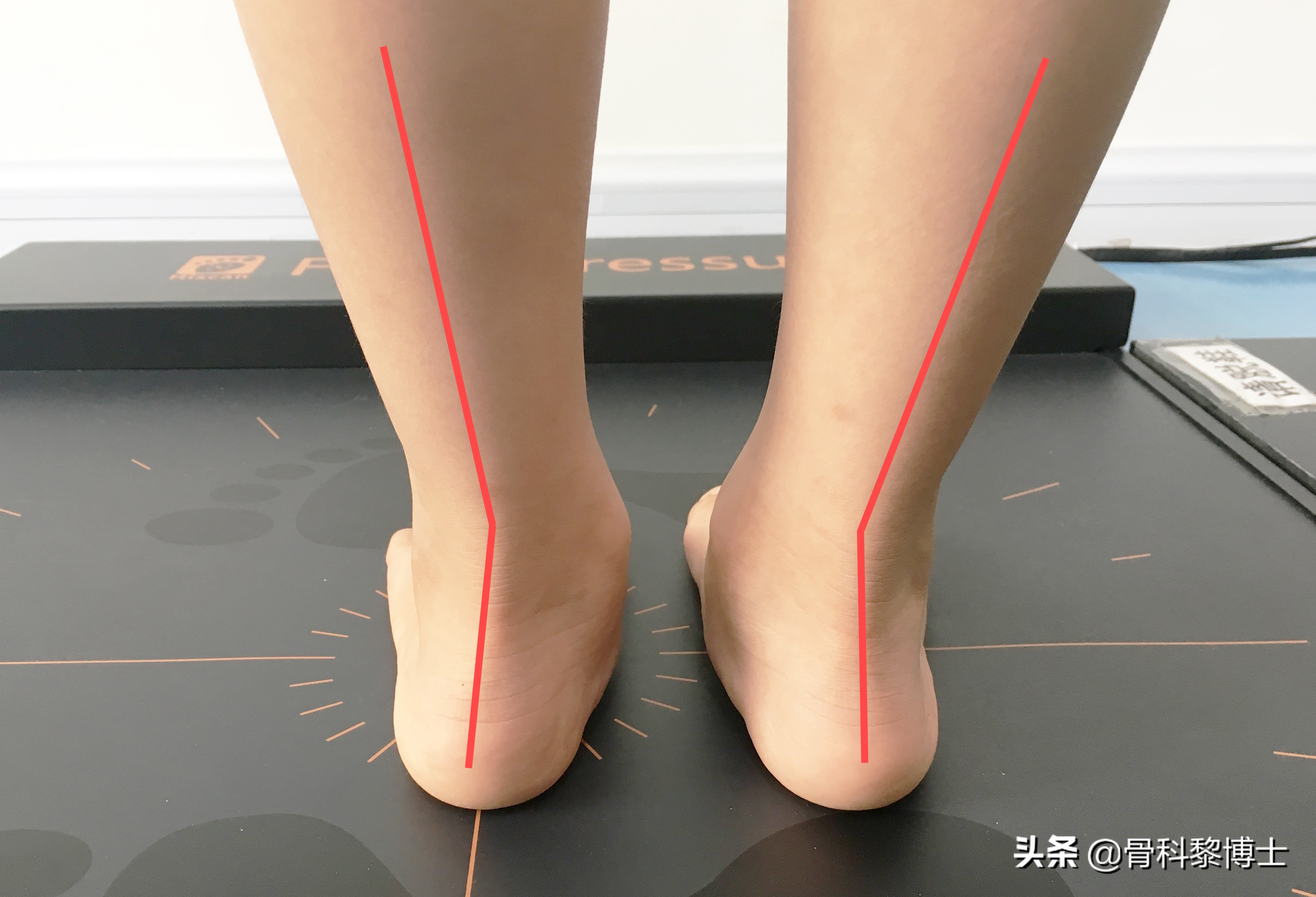 学生训练小腿疼痛是什么原因,中考体育1000米小腿痛