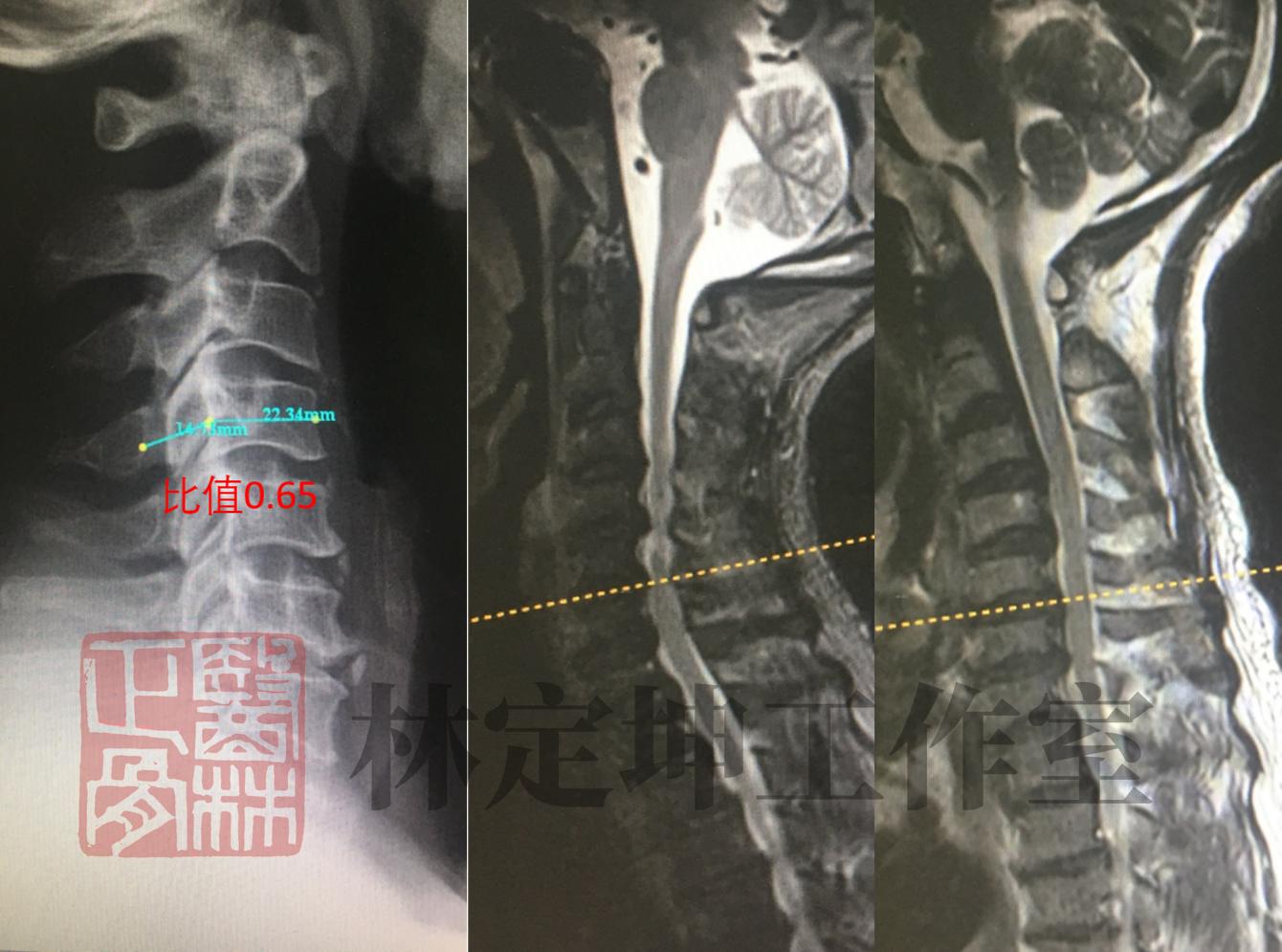 小圆枕会引起颈椎不稳吗,小圆枕治疗颈椎