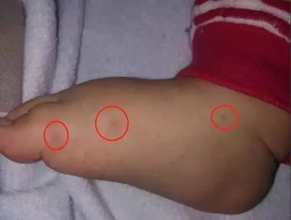 这一步才是治疗疱疹性咽峡炎的关键！做好预防和护理注意3件事