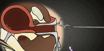 人流25天没做避孕措施会怀孕吗,怀不上做过一次人流影响吗