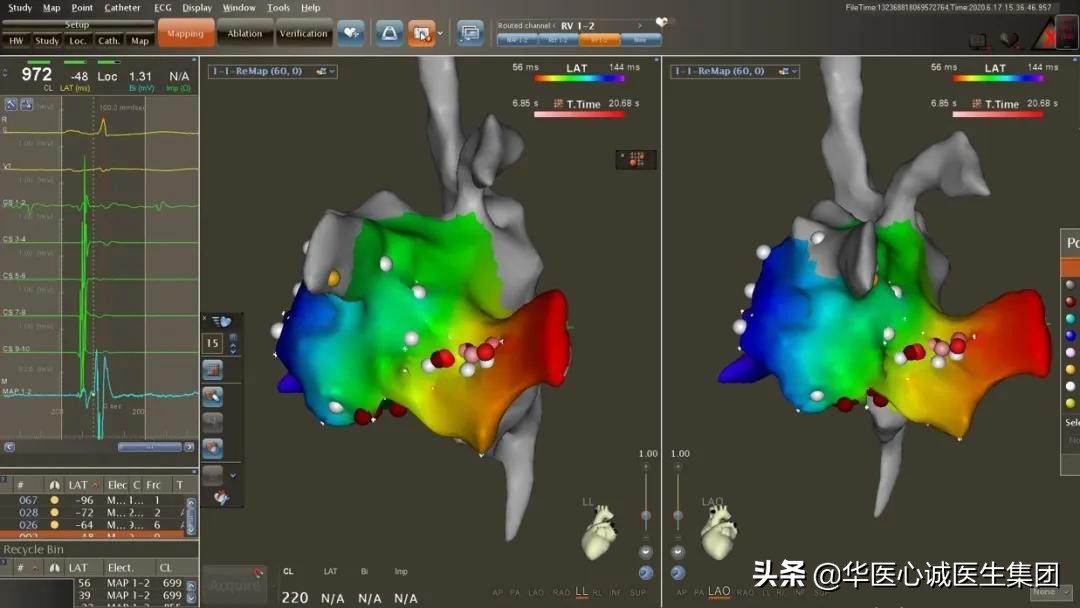 窦性心动过速查房,攀钢集团总医院心内科