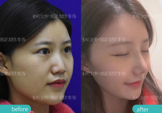 耳软骨隆鼻后吃什么恢复快,耳软骨隆鼻取出假体多久恢复原样