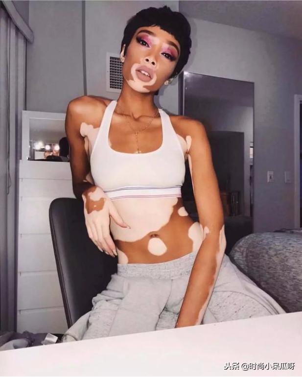 患白癜风的超模,有白癜风的国际名模