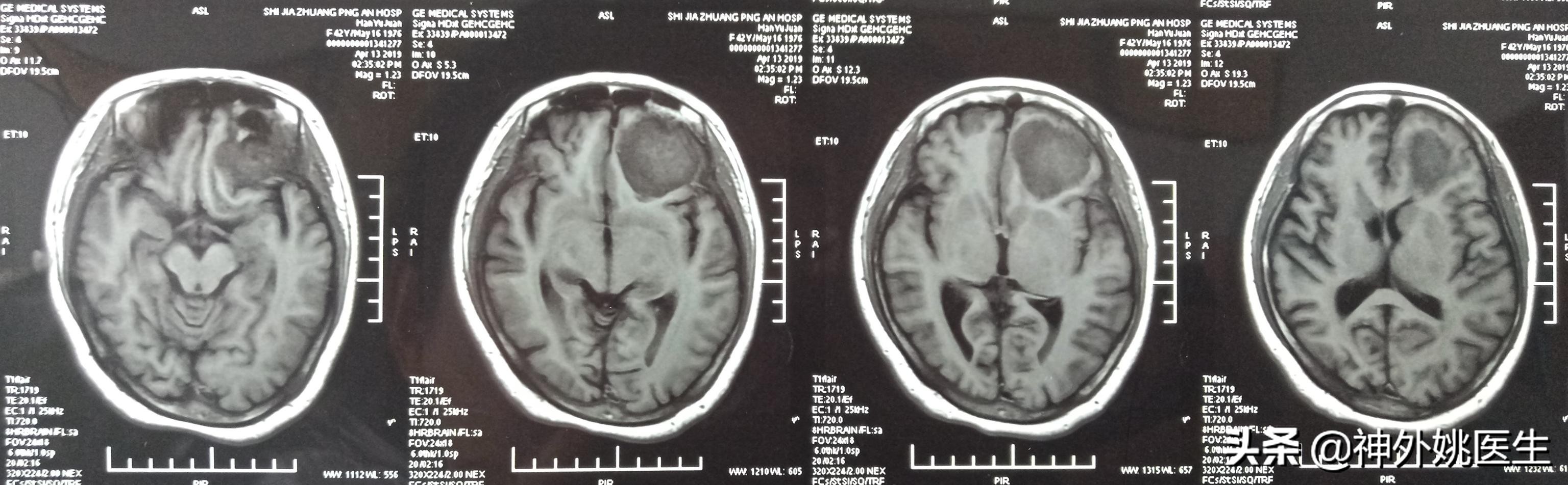 脑膜瘤是什么原因引起的啊,脑膜瘤手术治疗全部大概多少钱