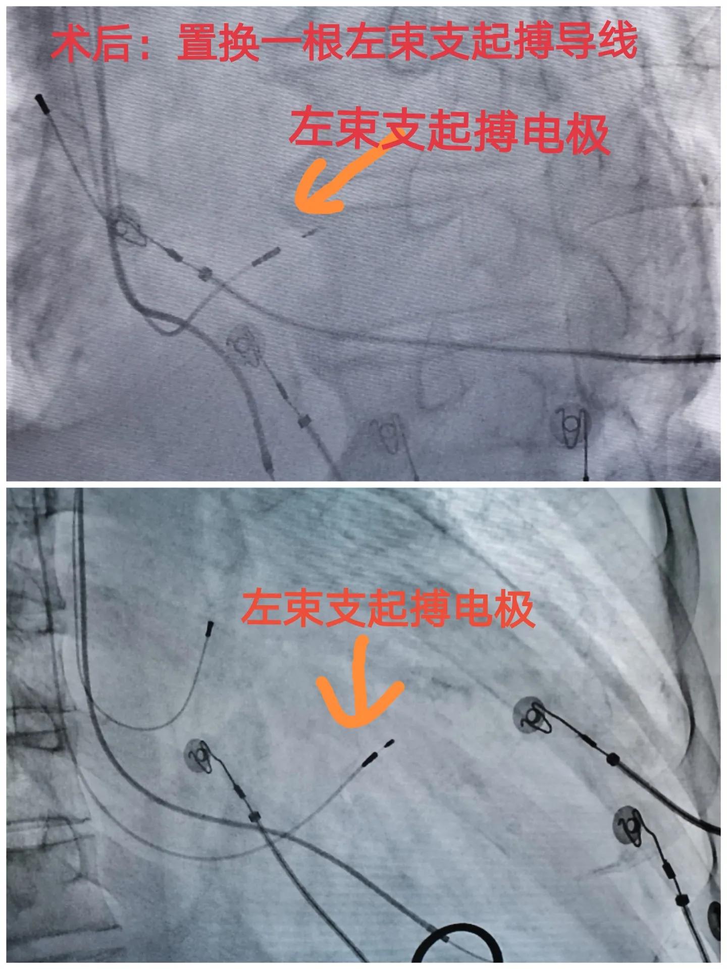 88岁老人心跳过快需要装起搏器吗,老人胸闷气短找中医看可以吗