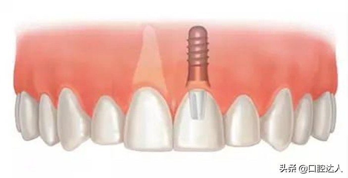 不是我吓你，掉1颗牙不管，周边3颗牙要遭殃