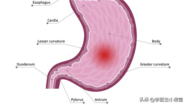 胃食管反流烧心可以喝牛奶缓解吗,治疗胃食管反流引起烧心的中成药