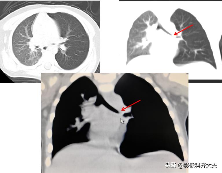 小儿气管镜怎么检查,小儿ct检查全过程视频