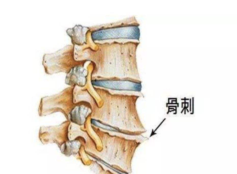 膝盖边有骨刺和增生用什么方法治,膝盖增生骨刺疼怎么治疗吃什么药