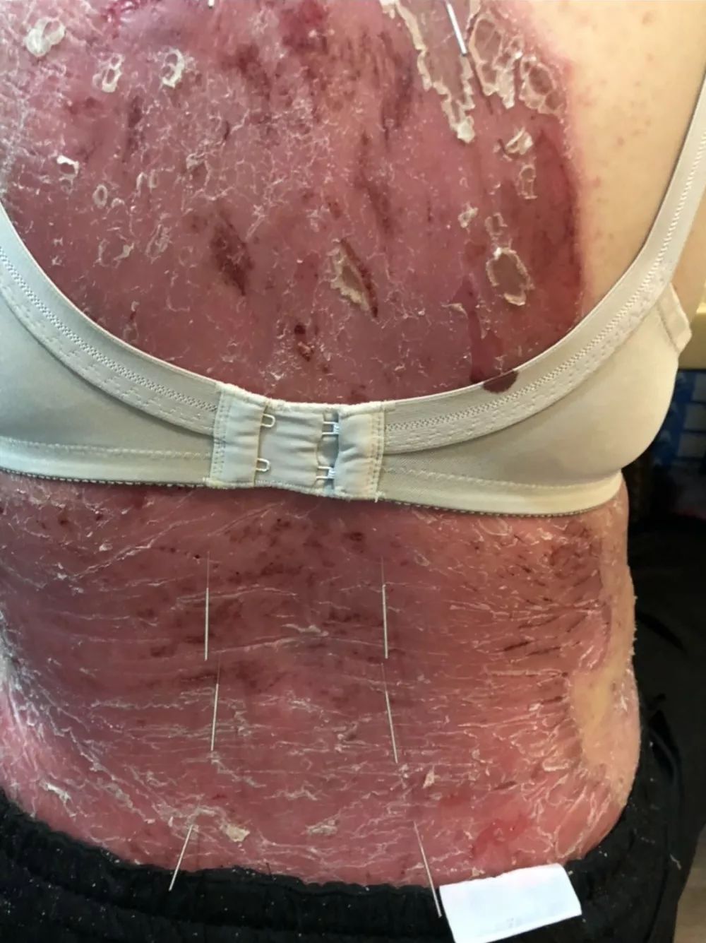 皮炎吃什么中成药能彻底根治,中医治疗皮炎一个疗程是多久