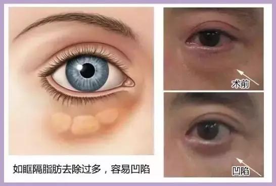 这些年我们踩过的护肤坑,目前最靠谱的去眼袋方法