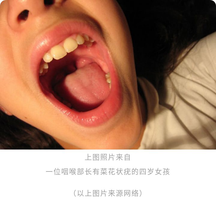 hpv阳性52导致宫颈癌的几率,由hpv引起的宫颈癌多吗