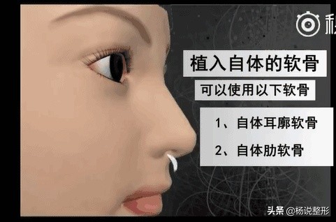 隆鼻整容老了会怎么样,隆鼻后老了