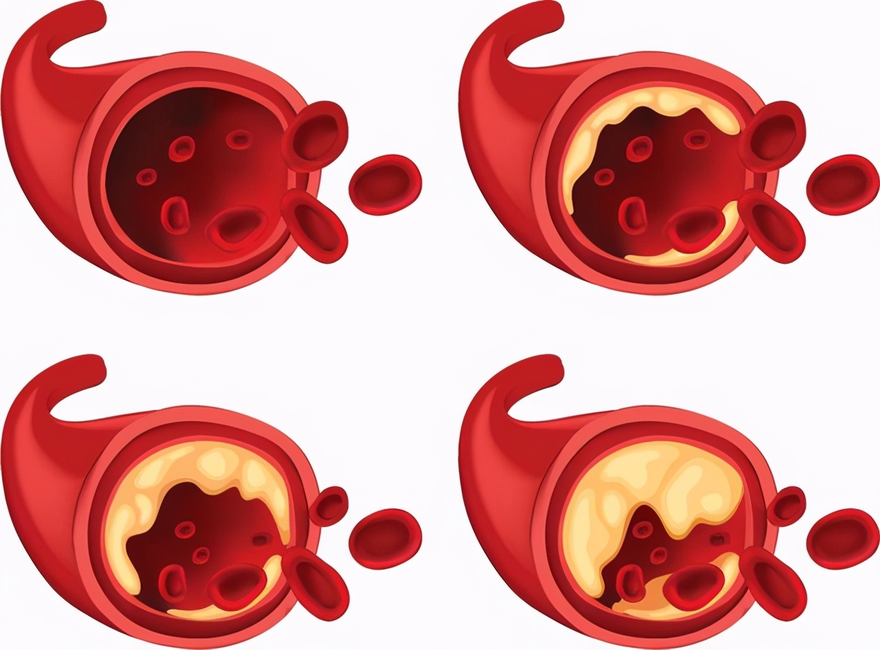 低密度脂蛋白胆固醇7.6怎么降,低密度脂蛋白胆固醇高3.79怎么降